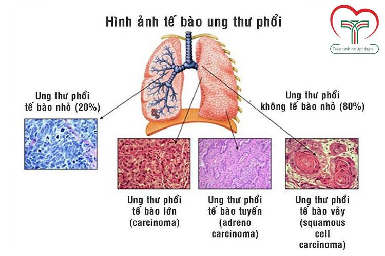 TIẾN BỘ ĐIỀU TRỊ MIỄN DỊCH UNG THƯ PHỔI TẾ BÀO NHỎ