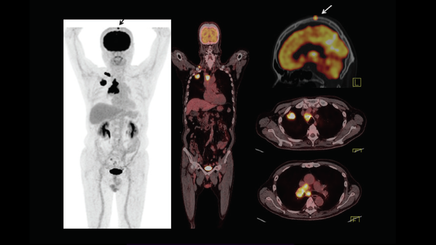 CHỤP PETCT VÀ ĐIỀU TRỊ TOÀN THÂN