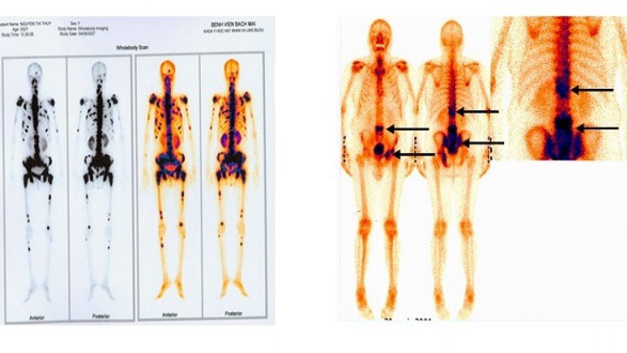 DI CĂN XƯƠNG UNG THƯ PHỔI ĐIỀU TRỊ BẰNG OSIMERTINIB (CHÙM CA BỆNH)