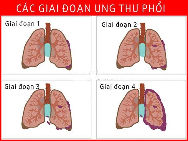 KÍCH THƯỚC KHỐI U VÀ BỔ TRỢ SAU MỔ GIAI ĐOẠN 1