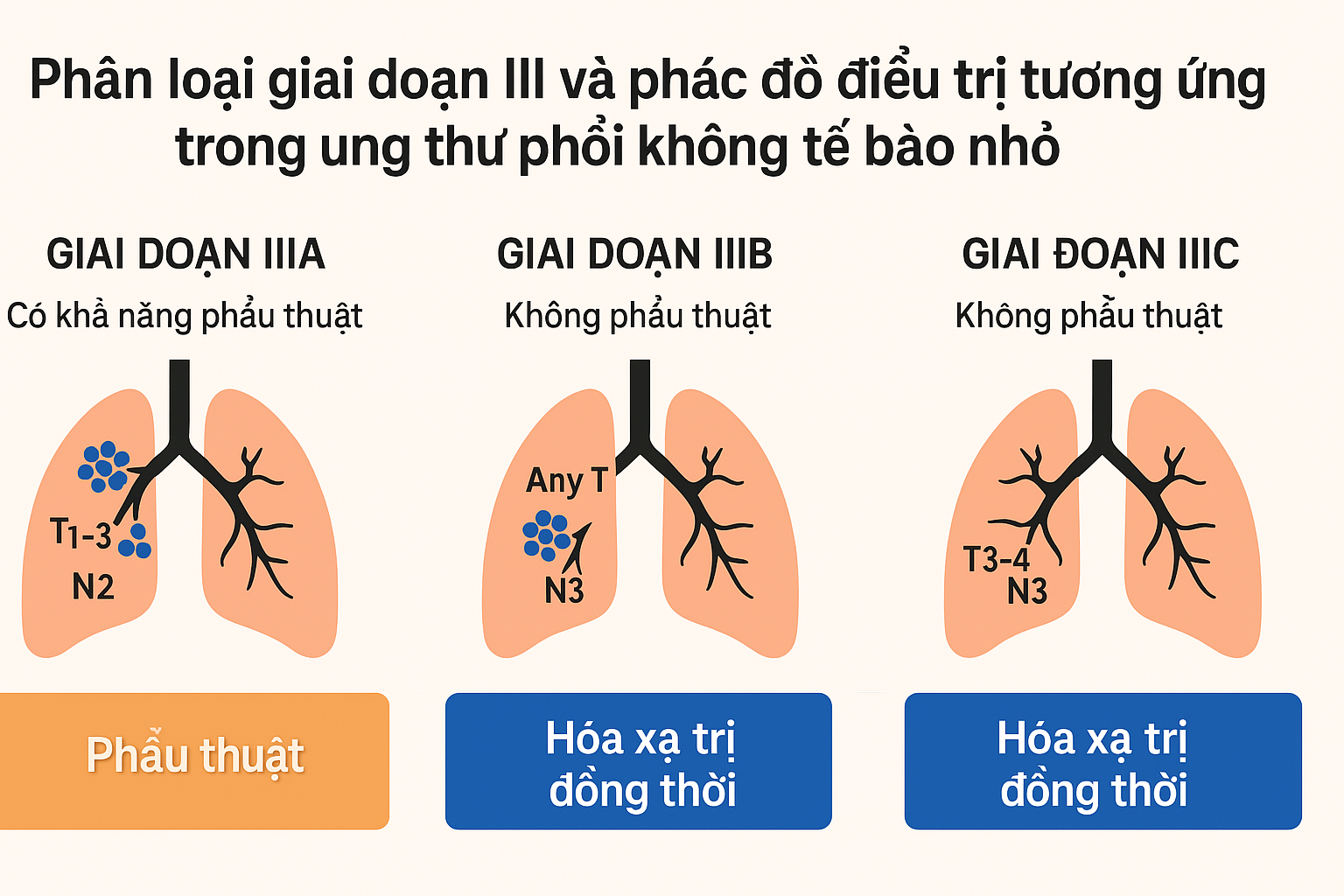 Phân loại ung thư phổi giai đoạn 3 và phác đồ điều trị tương ứng