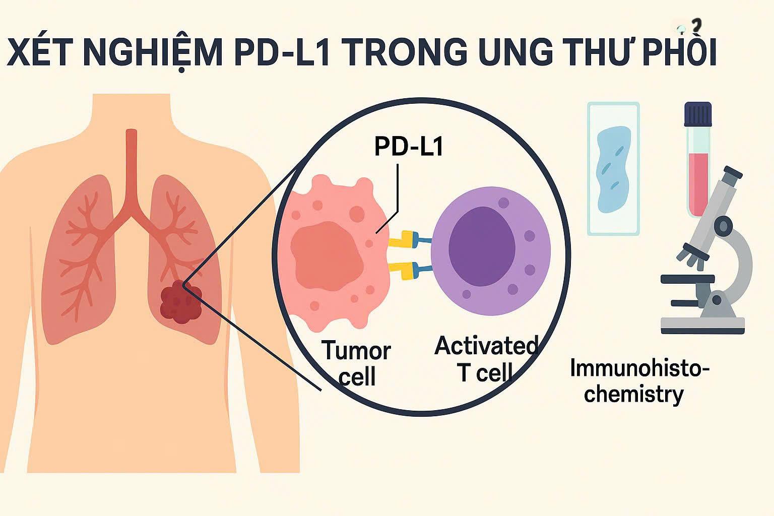 Xét nghiệm PD-L1 trong ung thư phổi: Cơ chế ức chế miễn dịch và ý nghĩa lựa chọn liệu pháp miễn dịch