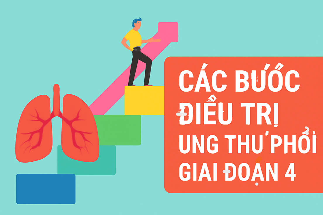 Hướng Dẫn Chi Tiết Các Bước Điều Trị Ung Thư Phổi Giai Đoạn 4 Theo NCCN 2025