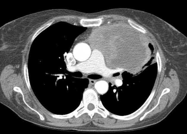 Zongertinib là gì? Thuốc đích mới cho đột biến HER2 trong ung thư phổi